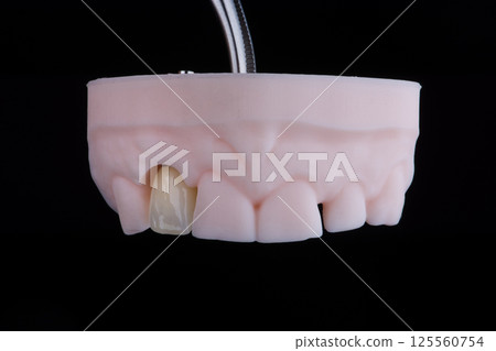 Lateral maxillary incisor made of zirconium, ultra thin dental ceramic veneer crown on printed model 125560754