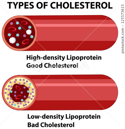 Understanding Types of Cholesterol Understanding Types of Cholesterol 125573615