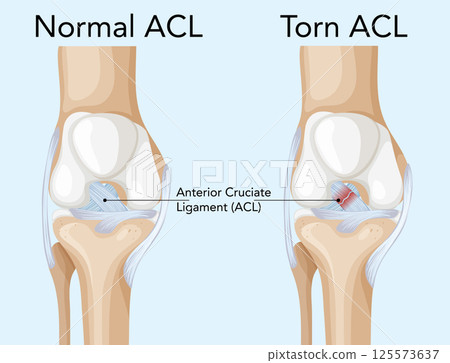 Comparison of Normal and Torn ACL Illustration 125573637
