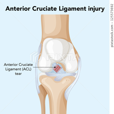 Detailed Illustration of Anterior Cruciate Ligament Injury 125573692