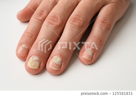 Close-up of caucasian hand with fungal infection on nails. concept of Nail fungus, health issues, care, and skin treatment awareness. 125581831
