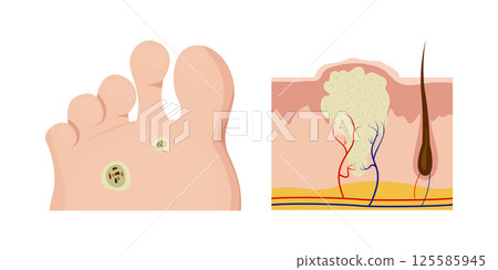 Plantar wart affecting skin layers and causing foot pain Plantar wart affecting skin layers and causing foot pain 125585945