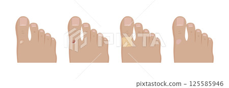 Friction blister developing and healing on toe, first aid treatment Friction blister developing and healing on toe, first aid treatment 125585946