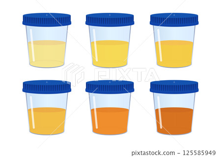 Medical urine test showing different colors. Medical urine test showing different colors. 125585949