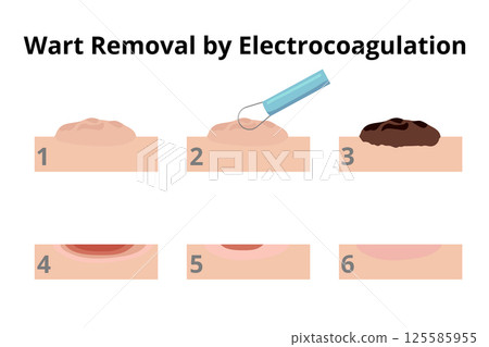 Dermatologist removing wart using electrocoagulation in six steps 125585955