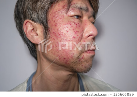 Shingles symptoms: Male in his 50s 125605089