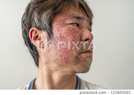 帶狀皰疹症狀：50多歲的男性 125605091