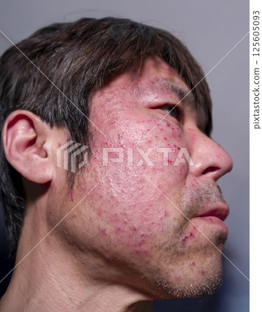 Shingles symptoms: Male in his 50s 125605093