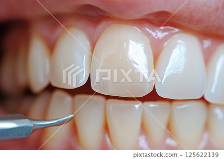 Close-up view of dental veneers showcasing a bright smile in a clinic setting Close-up view of dental veneers showcasing a bright smile in a clinic setting 125622139
