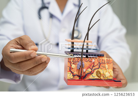 Hair transplant, Asian dermatologist doctor holding skin structure anatomy model for treatment in hospital. Hair transplant, Asian dermatologist doctor holding skin structure anatomy model for treatment in hospital. 125623653