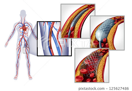 Peripheral Artery Angioplasty 125627486
