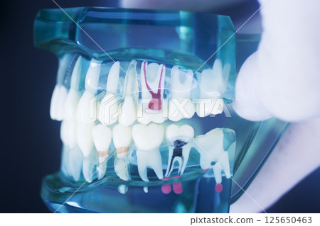 Tooth decay dental model Tooth decay dental model 125650463