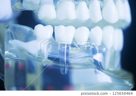 Dental tooth implant model Dental tooth implant model 125650464