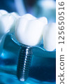 Dental tooth implant 125650516