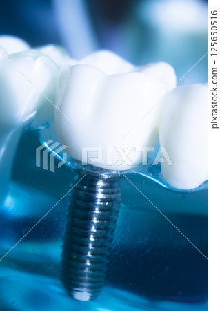 Dental tooth implant Dental tooth implant 125650516