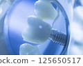 Dental tooth implant 125650517
