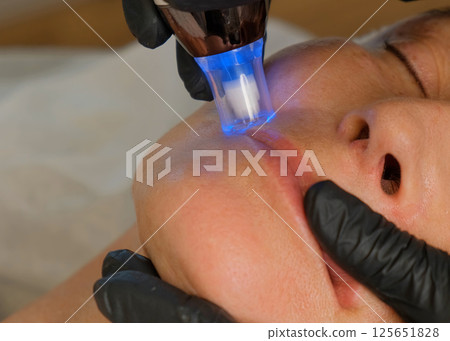 Close-up portrait of a beautiful aged woman during microneedling with dermapen from a beautician. 125651828