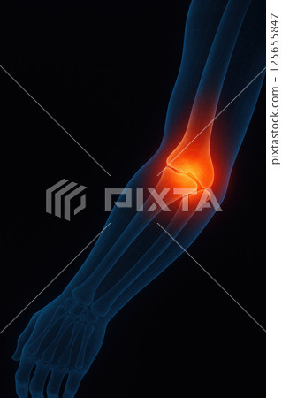 Digital illustration of human arm with highlighted elbow joint, showing inflammation or pain Digital illustration of human arm with highlighted elbow joint, showing inflammation or pain 125655847