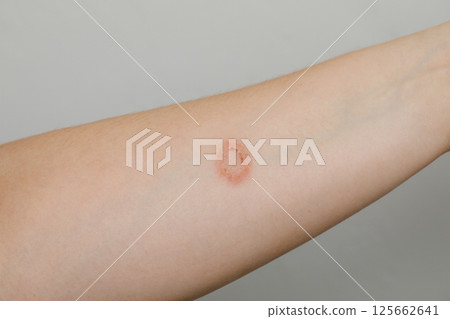 Contact Dermatitis or infection symptom on human skin Contact Dermatitis or infection symptom on human skin 125662641