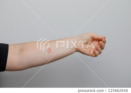 Hand with rash. Red psoriatic eruptions or inflamed eczema. Allergic urticaria problems Hand with rash. Red psoriatic eruptions or inflamed eczema. Allergic urticaria problems 125662648