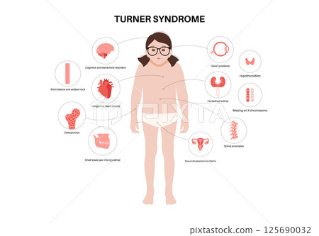 Turner syndrome poster 125690032