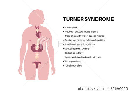 Turner syndrome poster 125690033