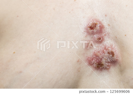 The wounds on the skin in the chest area. Pyoderma on woman body. Complications of the disease with the bacterial infection on skin The wounds on the skin in the chest area. Pyoderma on woman body. Complications of the disease with the bacterial infection on skin 125699606
