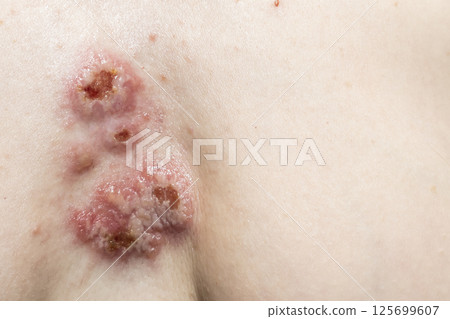 The wounds on the skin in the chest area. Pyoderma on woman body. Complications of the disease with the bacterial infection on skin The wounds on the skin in the chest area. Pyoderma on woman body. Complications of the disease with the bacterial infection on skin 125699607