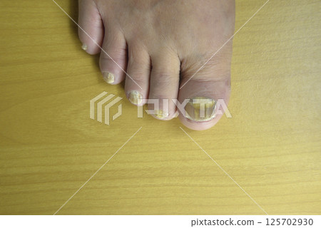 Athlete's foot on the toes of old people Athlete's foot on the toes of old people 125702930