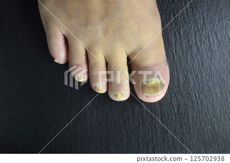 Athlete's foot on the toes of old people Athlete's foot on the toes of old people 125702938