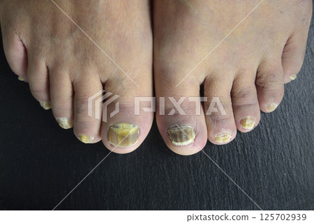 Athlete's foot on the toes of old people Athlete's foot on the toes of old people 125702939