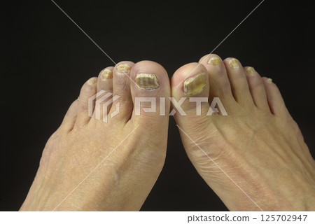 Athlete's foot on the toes of old people 125702947