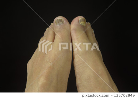 Athlete's foot on the toes of old people 125702949