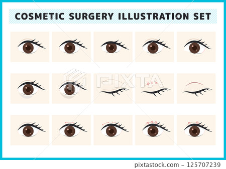 整容手術、眼部症狀及疾病插圖素材集 125707239