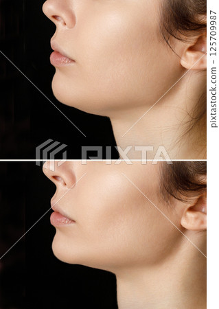 Female double chin before and after correction. Correction of the chin shape liposuction of the neck. The result of the procedure in the clinic of aesthetic ... Female double chin before and after correction. Correction of the chin shape liposuction of the neck. The result of the procedure in the clinic of aesthetic ... 125709987