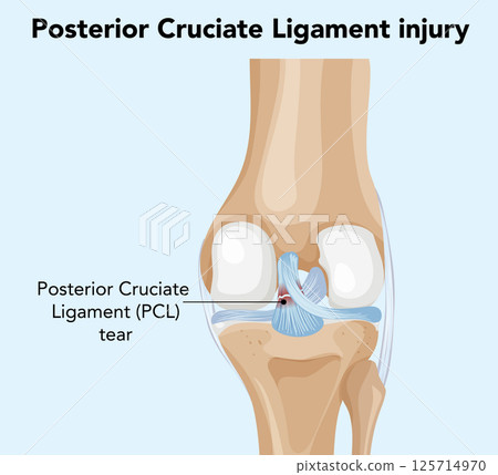 Posterior Cruciate Ligament Injury Illustration 125714970