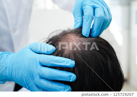 Doctor touch bold head in man, hair loss treatment health problem. 125729207