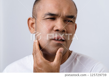 The man has facial swelling due to an allergic reaction to triggers such as insect bites stings 125729739