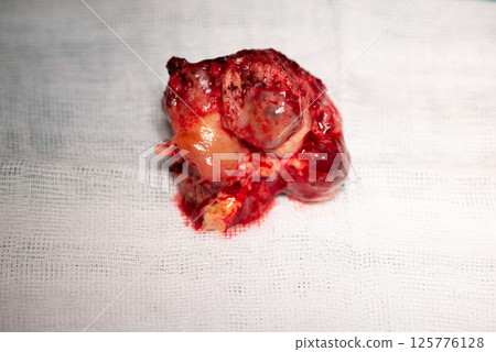 Removed metastatic brain tumor lies on white medical gauze, showcasing surgical procedure 125776128