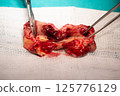 Surgical specimen of metastatic brain tumor is displayed on white gauze, held by forceps 125776129