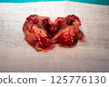 Removed metastatic brain tumor lies on white medical gauze, showcasing surgical procedure 125776130
