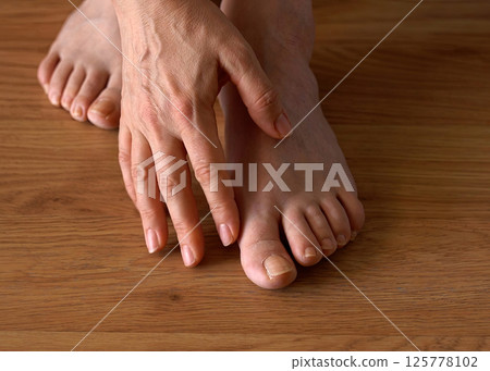 Close-up of a woman s foot with hallux valgus bunion and signs of toenail fungus. Her hand gently touches the deformed big toe, illustrating common foot problems and the need for medical care. Close-up of a woman s foot with hallux valgus bunion and signs of toenail fungus. Her hand gently touches the deformed big toe, illustrating common foot problems and the need for medical care. 125778102