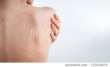 female back and shoulders of a woman with pimples and acne on skin on a white isolated background. Body of girl with problematic skin female back and shoulders of a woman with pimples and acne on skin on a white isolated background. Body of girl with problematic skin 125819474