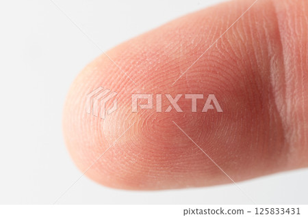 Hurted finger skin with blister Hurted finger skin with blister 125833431