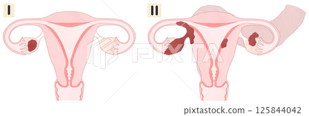卵巢癌 I 期和 II 期(1 期和 2 期)套裝,簡單易懂的圖表插圖 卵巢癌 I 期和 II 期(1 期和 2 期)套裝,簡單易懂的圖表插圖 125844042