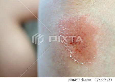 Close-up of healing skin with redness and peeling on caucasian boy Close-up of healing skin with redness and peeling on caucasian boy 125845731