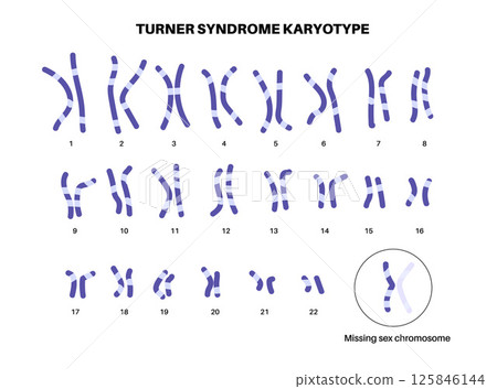 Turner syndrome poster 125846144