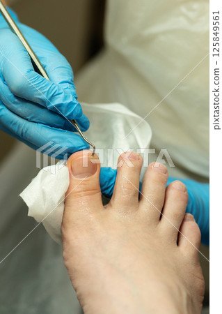 Podiatrist cleaning nail fold using metal probe and tissue. Podiatrist cleaning nail fold using metal probe and tissue. 125849561