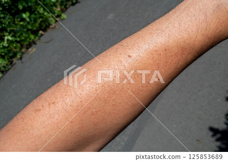 一名 40 多歲男子的手臂被曬傷 125853689