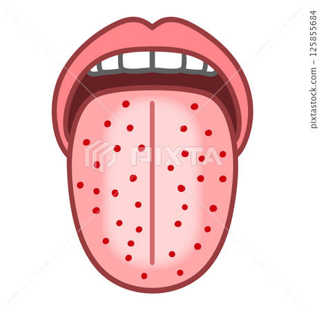 Illustration of a tongue with red eczema, strawberry tongue, and diseased tongue Illustration of a tongue with red eczema, strawberry tongue, and diseased tongue 125855684